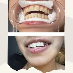 Blanquiamiento De Dientes