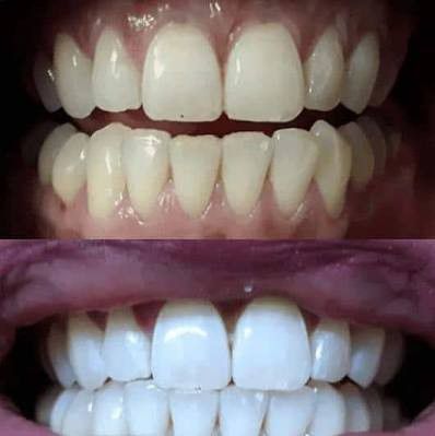 Advanced Teeth Whitening
