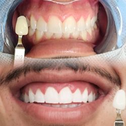 Blancamiento De Dientes