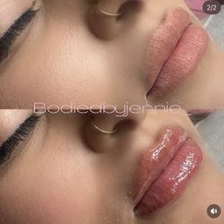 Lip Filler