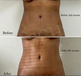 Post op lymphatic