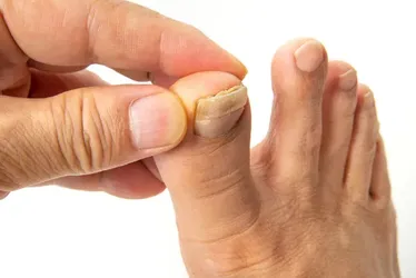 laser toenail fungus removal