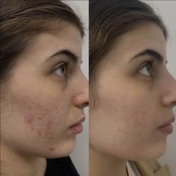 Jabon Para El Acné Y Manchas🧼