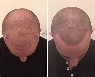 Scalp Micropigmentation