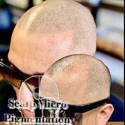 Hairloss Solutions- Scalp Micropigmentation