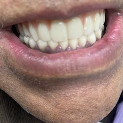 Dentures