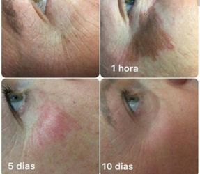 Tratamiento De Plasma Fibroblasto