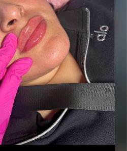 Lip filler