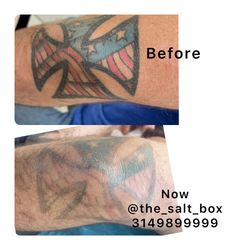 Free Consultation For Laser