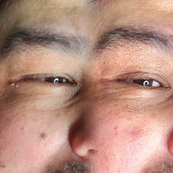 Skin Tag Removal