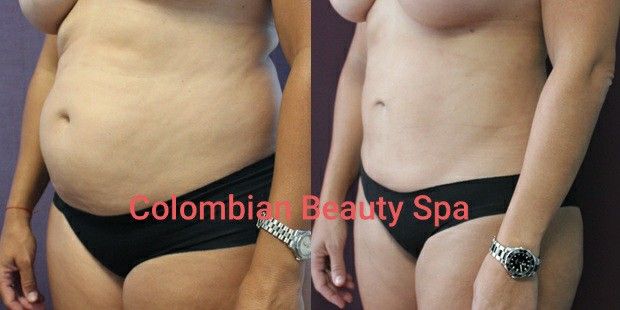 Lipo Enzimas Y Masaje Colombiano Reductor