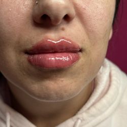 Lip Filler 
