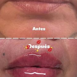 BOTOX EN LOS LABIOS PARA TENER UN EFECTO Voluptuoso Y Brillante