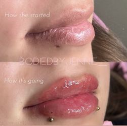 Lip Filler