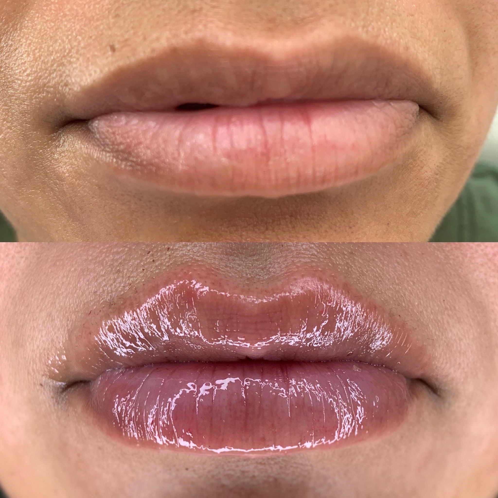 đź’‹LIP FILLERđź’‹