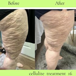 Tratamiento De Celulitis 