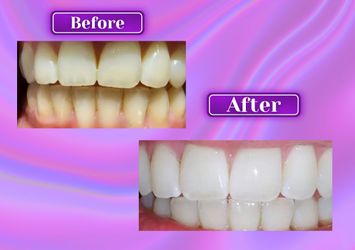 Teeth Whitening Services