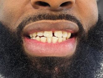 Composite Resin $2000 Included 20 Teeth 