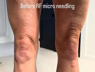 Skin tightens