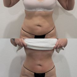 Body Contouring