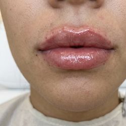 Lip Filler 