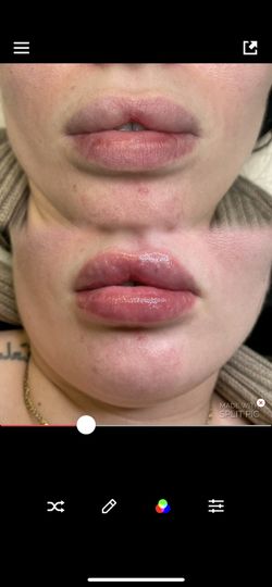 Lip Fill For Sale