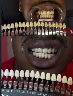 teeth whitening and toothgem’s!