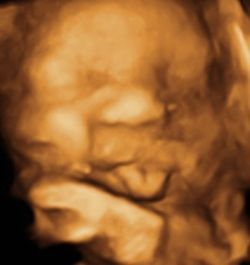 4D Ultrasound