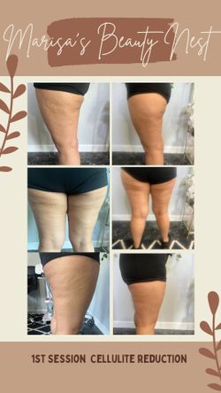 Body Contouring