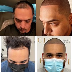 Hair Loss or No Hair Loss