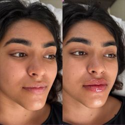 Lip filler