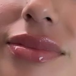 Lip Fillers 
