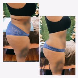 Body sculpting Machine