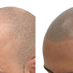 Hair Lost , Look Younger Again Guaranteed 