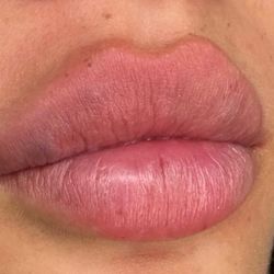 Lip Injections Lip Filler 