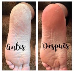 Tratamiento Para Pies