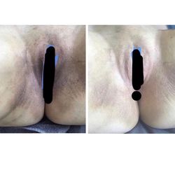 Intimate skin lightening services