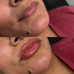 Lip Fillers On sale For January