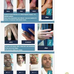 Ozon 365 OZONAID Multi-Repair Treatment Cream with Ozonized Olive Oil for Burns & Skin Care