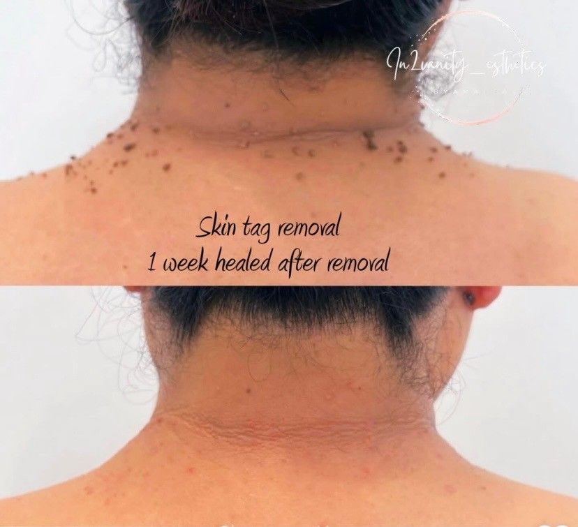 Skin Tag Removal, Plasma Fibroblast Skin Tightening