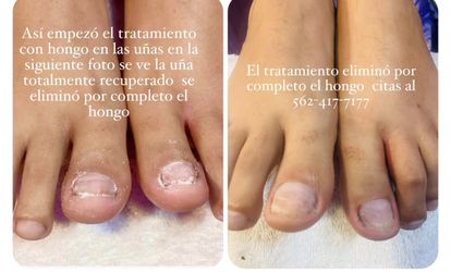 Hongos Tratamiento 