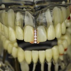 Rose Gold Single Tooth Grillz with CZ Stones