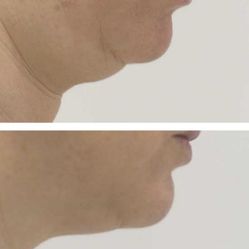 Lipo / Weight 