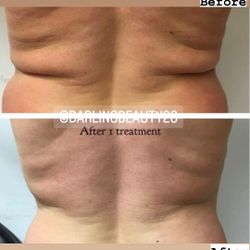 Lipo