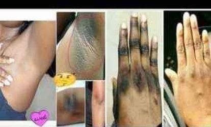 Whitening Soap For Dark Spots Para Todo Tipo De Manchas