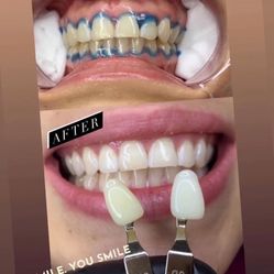 Blanqueamiento De Dientes