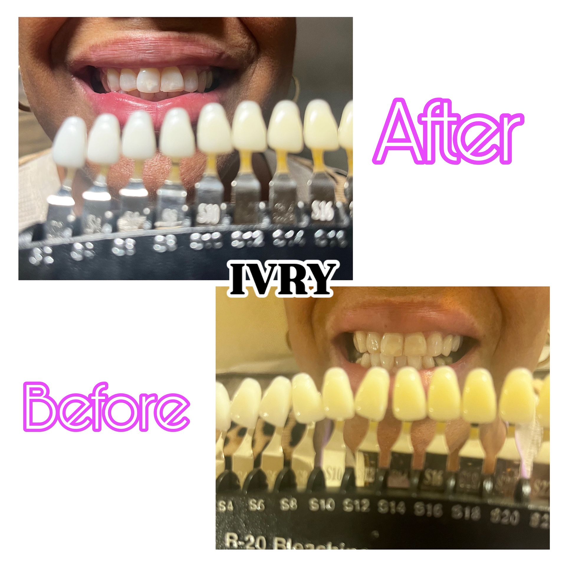 Teeth Whitening & Teeth Gems