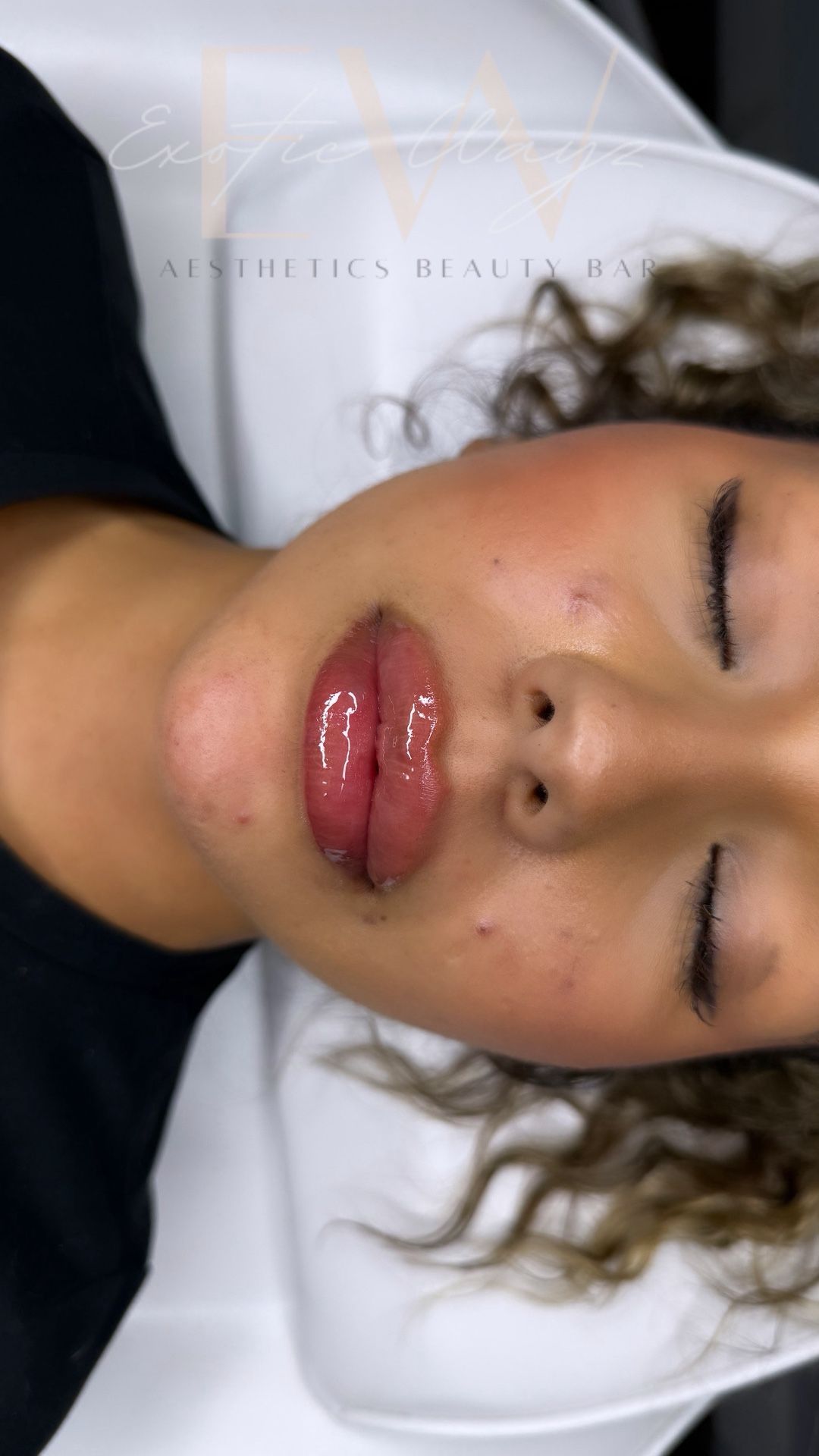 Lip Filler (microneedle) ππ