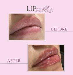 Lip Filles 