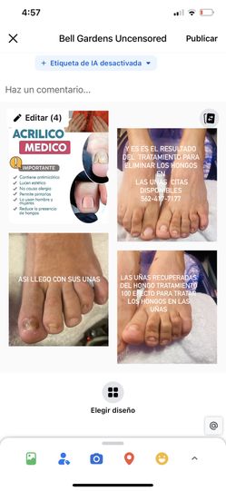 Tratamiento Para Eliminar Los Hongos En Las Uñas 